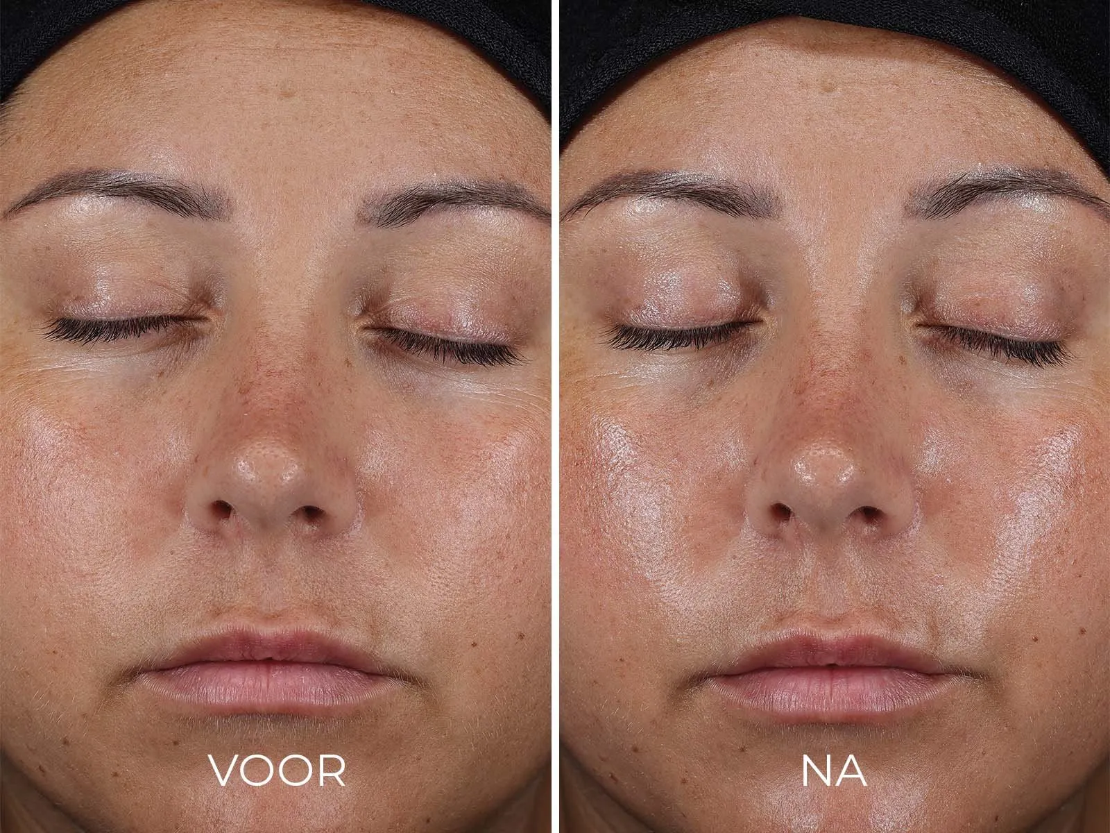 DAILY PREVENTION Ultra Defense Moisturizer SPF 50 - voor en na foto