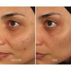 Resultaat IMAGE Skincare ILUMA Intense facial illuminator