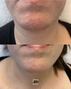 Voor en na ongewenste haargroei kin behandeling met laser bij JMH de Huidkliniek Deventer